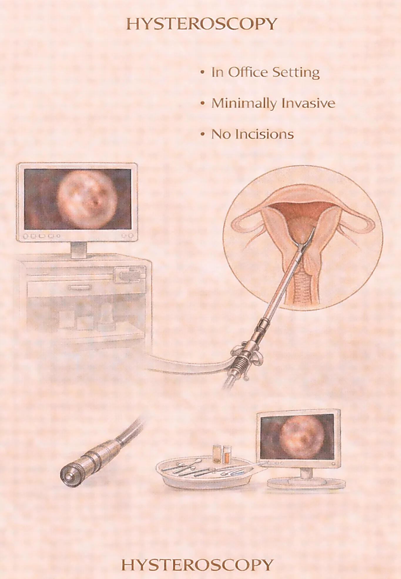 Hysteroscopy Procedure - Medical illustration showing minimally invasive in-office hysteroscopy with camera visualization of uterine cavity, no incisions required